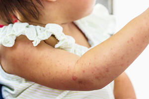 Bộ Y tế đề nghị xử lý triệt để các ổ dịch bệnh ho gà